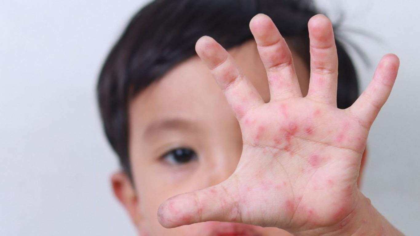 Enfermedad de Manos, Pies y Boca imagen novedad